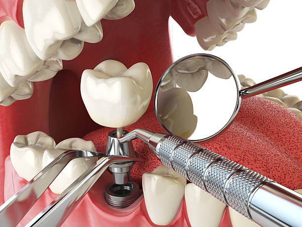 Best Tooth Infection Emergency Dentist  in Glenwood, MN